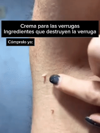 COMBO: 1 CREMA + 1 SERUM Eliminador de Verrugas, forma segura y sin dolor! | resultados en semanas – 50% de DESCUENTO